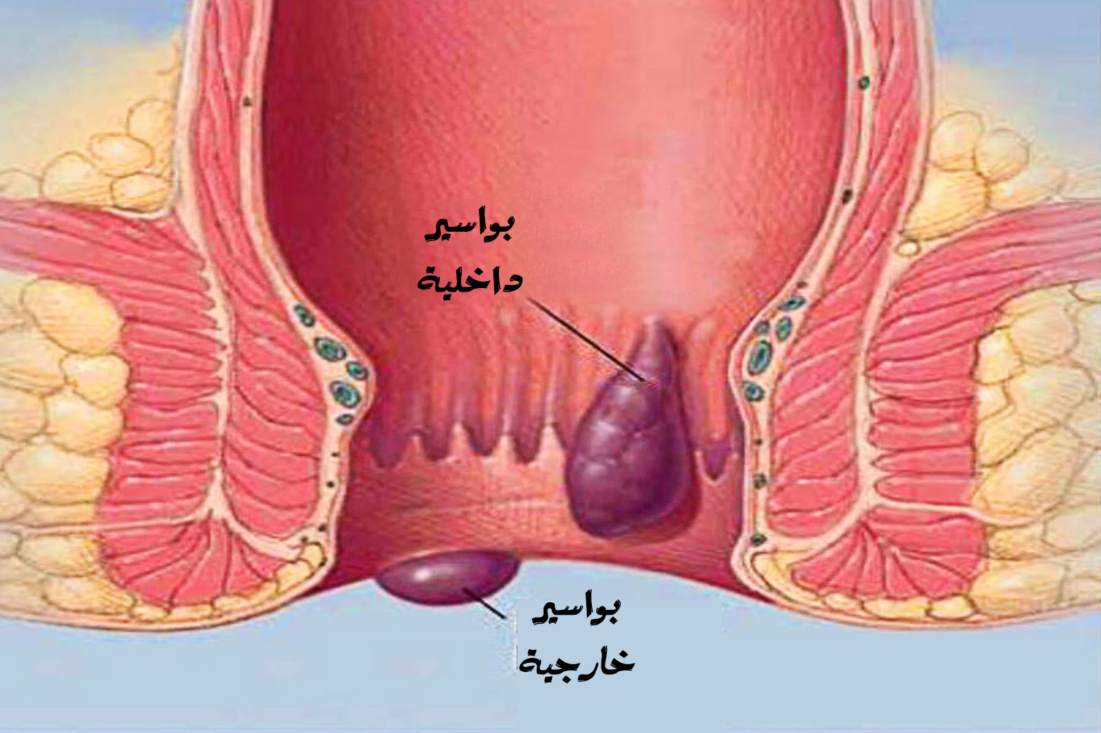 علاج البواسير - طريقة من افضل الطرق لعلاج البواسير في عام 2019 م 4786