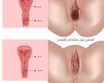 عمليات تجميل المهبل بالصور قبل وبعد , كيف يتم تضييق فتحه المهبل تجميليا