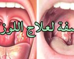 علاج التهاب اللوزتين , التهاب اللوز وعلاجه