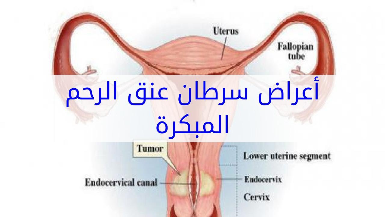 اعراض سرطان الرحم - ظواهر مرض ورم الرحم 3672 2