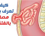 اعراض الفتق الاربي عند الرجال , اسباب وعلاج واعراض الفتق عند الرجال