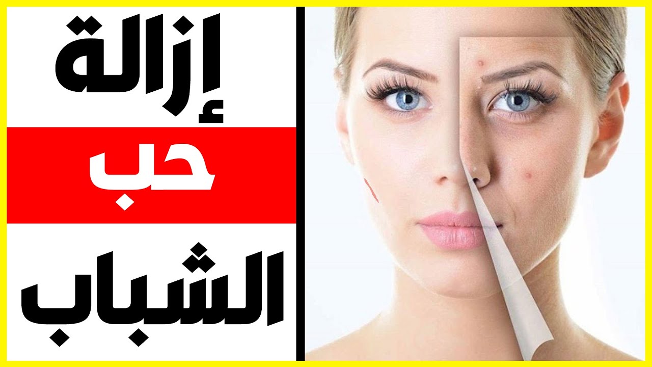 اسعار علاج حب الشباب بالليزر - اكثر المشكلات التى تواجه الشباب