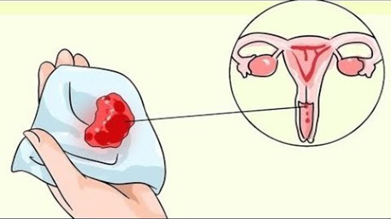 اعراض سرطان الرحم - ظواهر مرض ورم الرحم