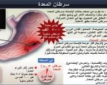 اعراض سرطان المعدة , اكتشف اعراض سرطان المعده