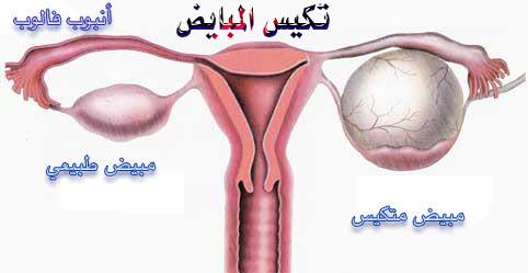 علاج التكيس - طرق علاج التكيس باذن الله