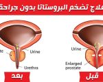 علاج تضخم البروستاتا , اعراض مرض تضخم البروستاتا وعلاجه