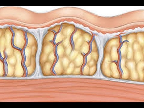 ما هو السيلوليت - التعامل مع السيلوليت