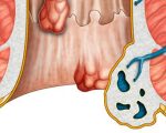 بواسير خارجية بالصور , اعراض واسباب البواسير التى تخرج بشكل بارز