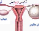 علاج التكيس , طرق علاج التكيس باذن الله