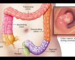 اعراض سرطان القولون , ورم القولون وظواهره