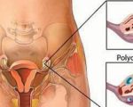 ماهي اعراض تكيس المبايض - مؤشرات تعني اصابة مبايض النساء
