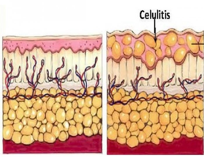 ما هو السيلوليت - التعامل مع السيلوليت 2055