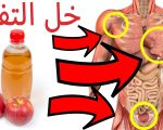 اضرار خل التفاح للتخسيس