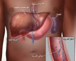 اعراض دوالى المرئ , عروض واسباب الدوالي تشخصها وعلاجها