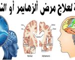 علاج النسيان , ماهو علاج النسيان؟