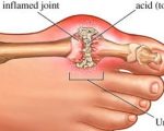 مرض النقرس , معلومات الامراض