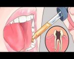 تسكين الم الاسنان , علاج الام الضروس