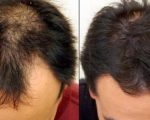 علاج تساقط الشعر للرجال , كيفية ايقاف تساقط الشعر للرجال