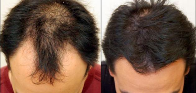 علاج تساقط الشعر للرجال , كيفية ايقاف تساقط الشعر للرجال