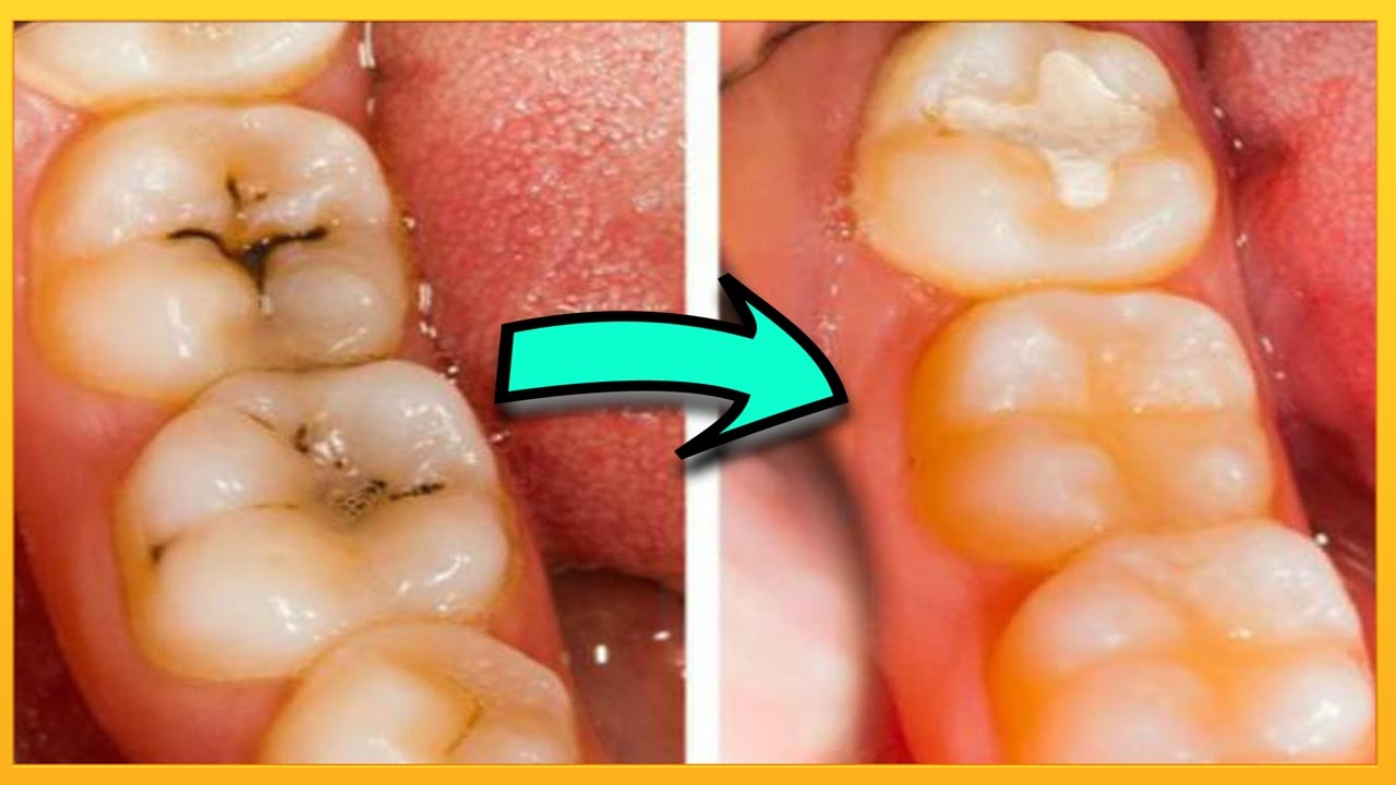 علاج تسوس الاسنان , تخلص من التسوس اليوم
