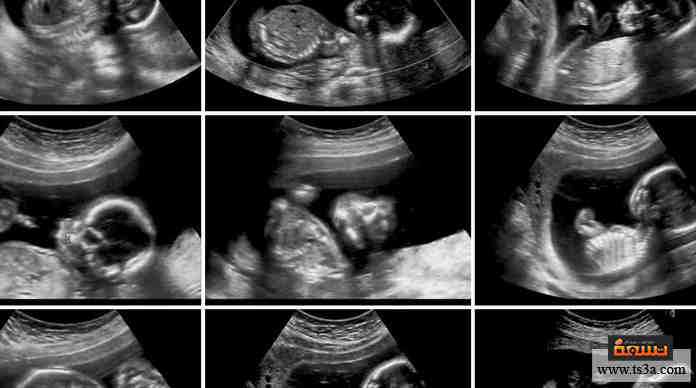 شكل بطن الحامل ببنت او ولد بالصور