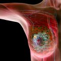 1232 3 مرض سرطان الثدي - اهم اعراض سرطان الثدي ام هاجر