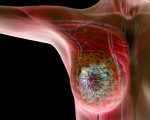 مرض سرطان الثدي , اهم اعراض سرطان الثدي