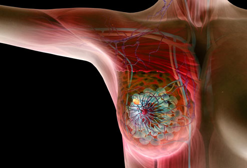 مرض سرطان الثدي , اهم اعراض سرطان الثدي