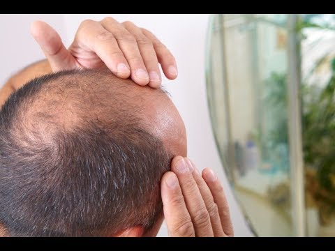 علاج الصلع الوراثي , طريقة ايقاف جين الصلع الوراثي واعادة انبات الشعر من جديد