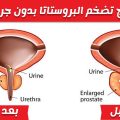 5648 3 علاج تضخم البروستاتا - اعراض مرض تضخم البروستاتا وعلاجه عبد الستار