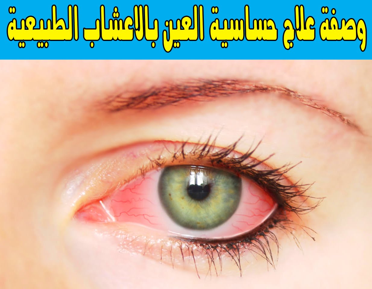 علاج حساسية العين , افضل علاج لحساسيه العين