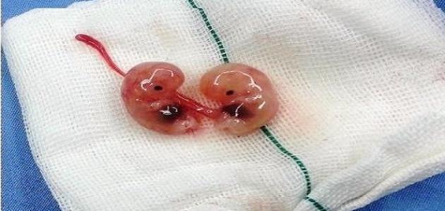 اجهاض الجنين , طرق انزال الجنين قبل تكوينه
