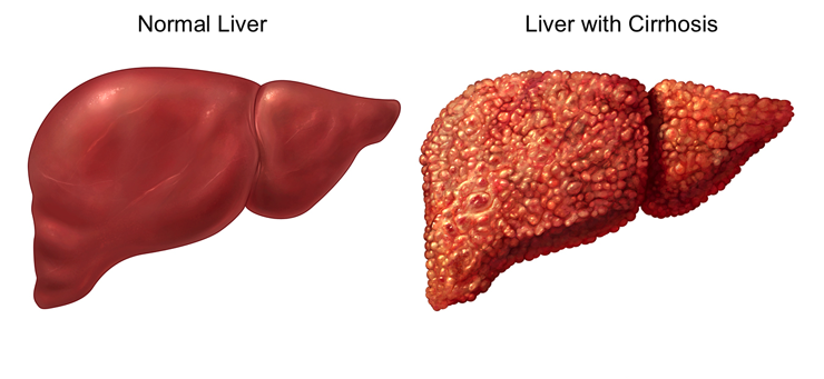علاج تليف الكبد , ماالاشياء التي تساعد علي علاج تليف الكبد
