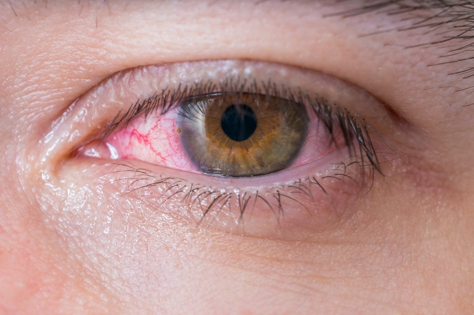 العين الحمراء , اسباب وعلاج العين الحمراء