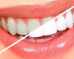 خلطات تبيض الاسنان , ابتسامتك اجمل مع وصفات تجعل اسنانك كاللؤلؤ في ثلاثة ايام