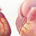 13506 2 ما هو تضخم القلب - اعراض مرض تضخم القلب U2