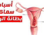 علاج سماكة بطانة الرحم , من اكثر الاسباب التى تؤخر الحمل