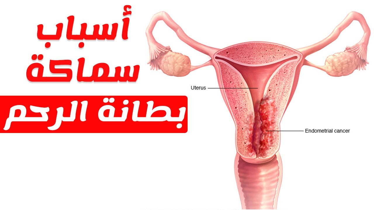 علاج سماكة بطانة الرحم , من اكثر الاسباب التى تؤخر الحمل