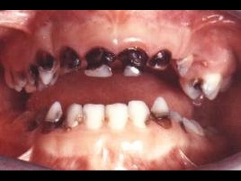 صورة اسنان مسوسة , اسباب تسوس الاسنان وكيفية الوقاية منه
