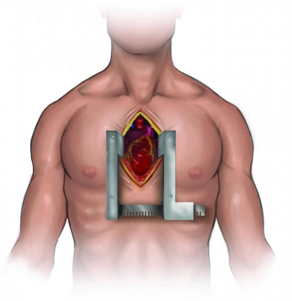 13048 1 ما هي عملية القلب المفتوح- تعرفوا بكل سهوله على عمليات القلب المفتوح U2