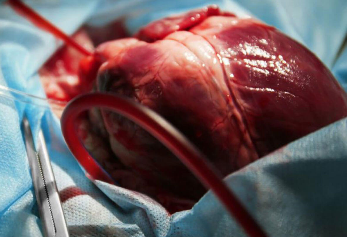 13048 2 ما هي عملية القلب المفتوح- تعرفوا بكل سهوله على عمليات القلب المفتوح U2