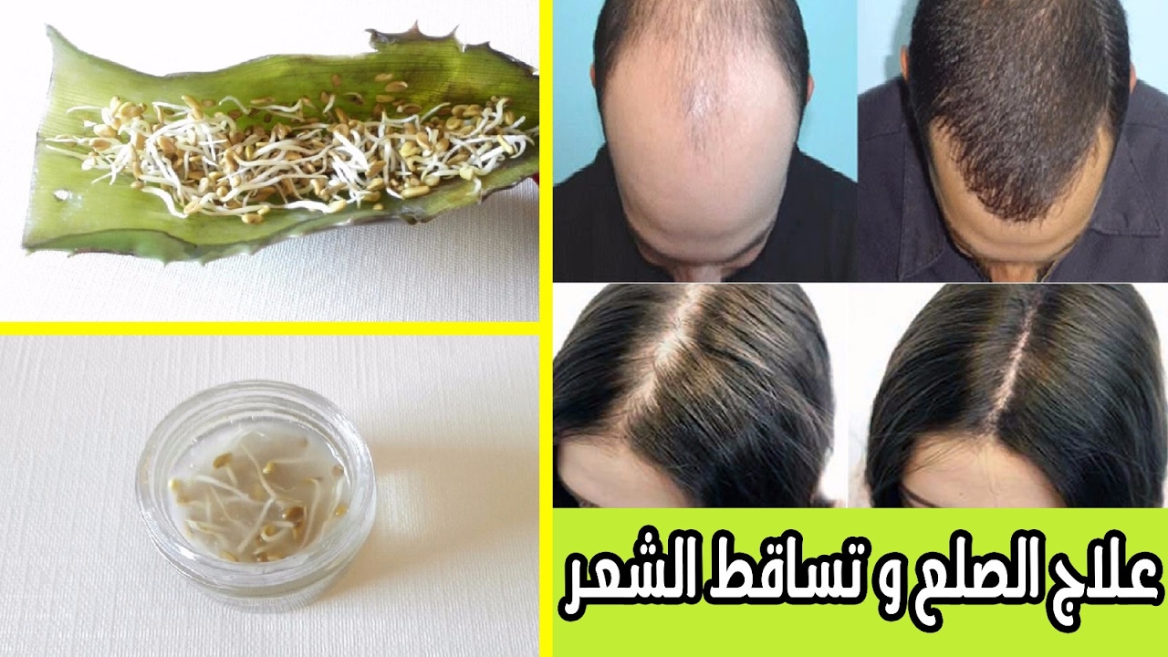 علاج سقوط الشعر , اسباب واعراض وعلاج الشعر المتساقط